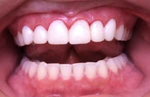 Veneers